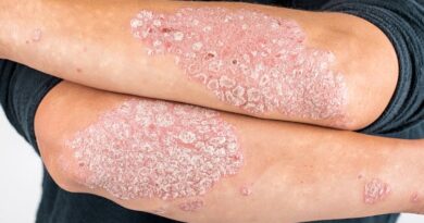 Psoriasis: la solución está en el sistema inmunitario