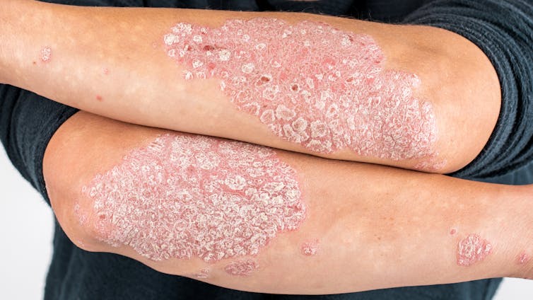 Psoriasis: la solución está en el sistema inmunitario